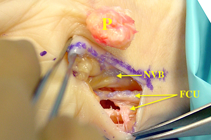 Excision of the pisiform. Pisiform completely removed (P). The neurovasciular bundle (NVB) i.e. ulnar artery and nerve intact. Flexor Carpi Ulnaris (FCU) split to be sutured before closure.