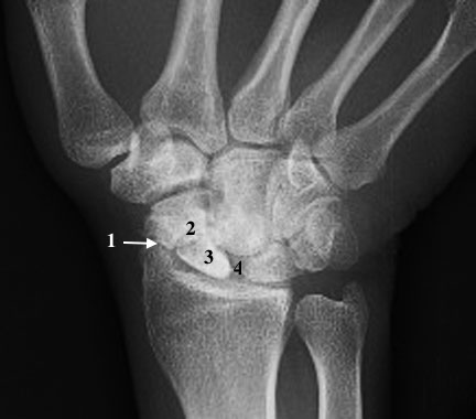 SNAC Wrist with arthritic radioscaphoid joint (1) ;  scaphoid nonunion (2) ; (3) AVN ; (4) S-L gap