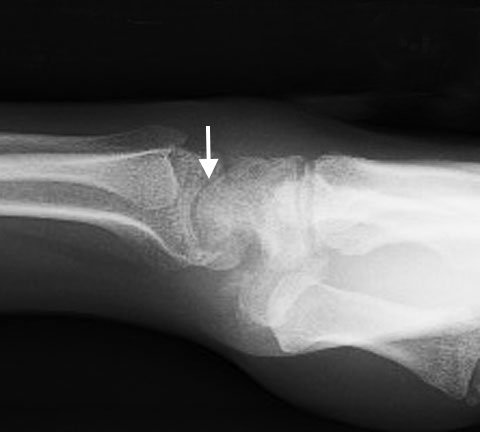 SNAC Wrist after proximal row carpectomy (PRC) Note intact radiocapitate joint space (arrow)