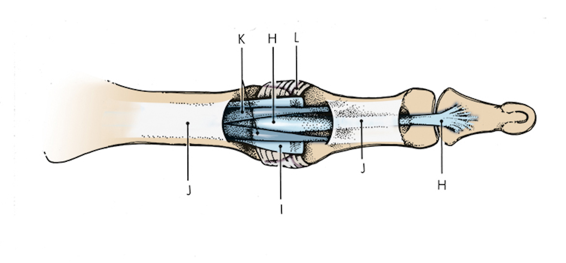 H. Flexor digitorum profundus; I. Volar plate; J. A-2 & A-4 pulley; K. Flexor digitorum superficialis; L. Transverse retinaculum.  During a volar plate injury which can cause a swan neck deformity, the volar plate (I) detaches from the base of the middle phalanx.