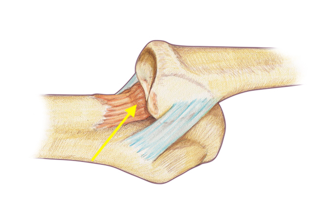 Dorsal view of complex dorsal MP dislocation