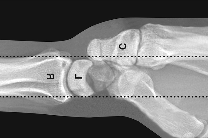 Diagrammatic lateral x-ray of a perilunate dorsal dislocation.  R-radius; L-lunate which is still seated in the lunate facet of the distal radius; C-capitate which is displaced dorsally.