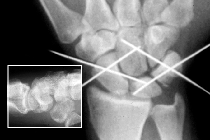 Right dorsal perilunate dislocation (insert) reduction, pinning and ligament repairs.