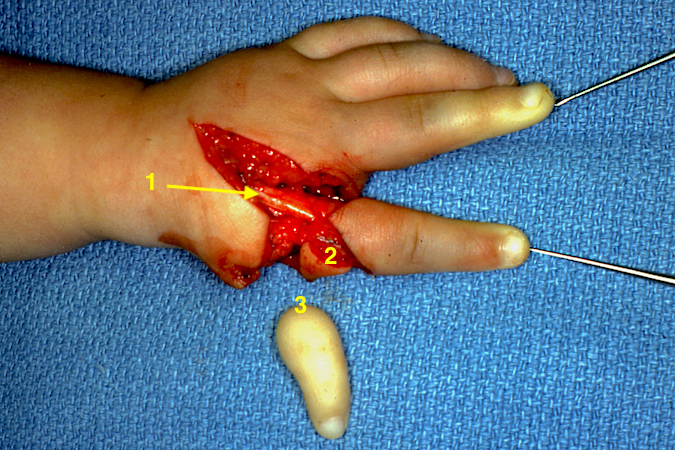 Left Hypoplastic Thumb Type 4 Pollicization:  Carroll style incisions opened with exposed extensor tendons (1); web flap before elevation on palmar base (2); amputated pouce flottant (3).
