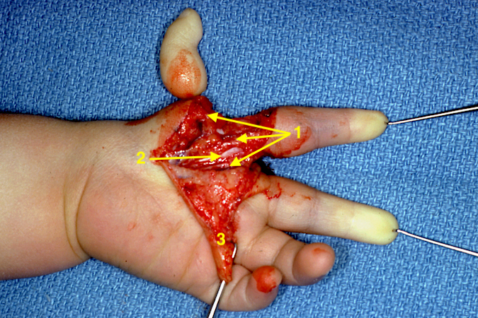 Left Hypoplastic Thumb Type 4 Pollicization: Neurovascular bundles (1); Flexor tendons index (2);  Palmar flap for web reconstruction (3)