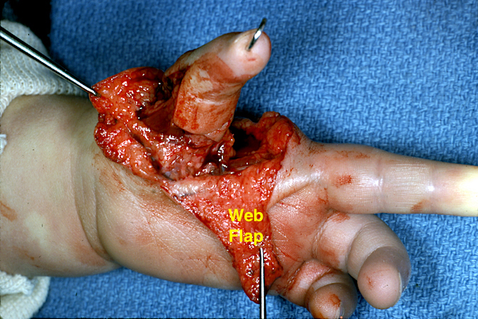 Left Hypoplastic Thumb Type 4 Pollicization with thumb held in new position with a K-wire and web flap retracted.