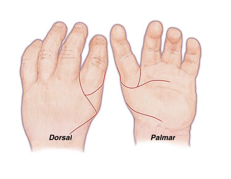 Carroll's dorsal and palmar incisions for pollicization of the index finger.