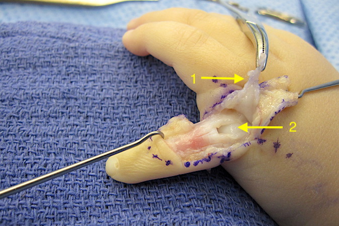 Left fifth finger polydactyly with dorsal incision opened, extensor retracted (1) and bifid portion of the metacarpal head visible (2).