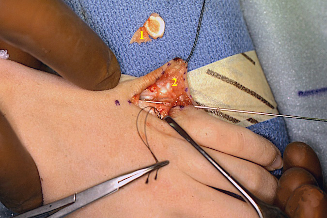 Left fifth finger polydactyly. Note excised metacarpal head (1), collateral ligament (2) and K-wire used to localize the osteotomy line.