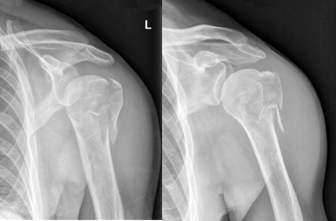 Comminuted closed left proximal humerus fracture