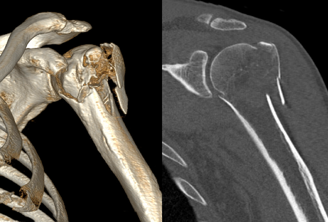 CT of comminuted closed left proximal humerus fracture