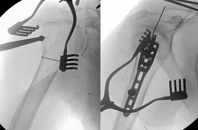 ORIF of comminuted closed left proximal humerus fracture