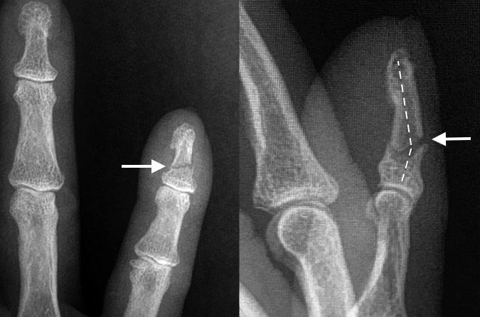 Distal phalanx shaft fracture (arrow) AP & Lat with dorsal apex 