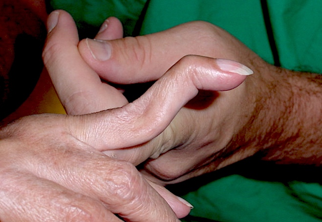 Swan neck deformity secondary to rheumatoid arthritis