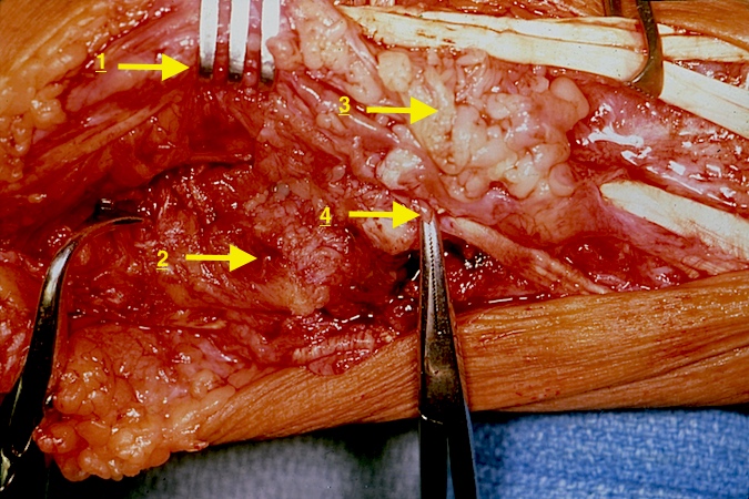 RA: (1) Retracted opened DRUJ capsule, (2) Distal with absent cartilage, (3) Hypertrophic dorsal tenosynovitis, & (4) Ruptured tendon end.