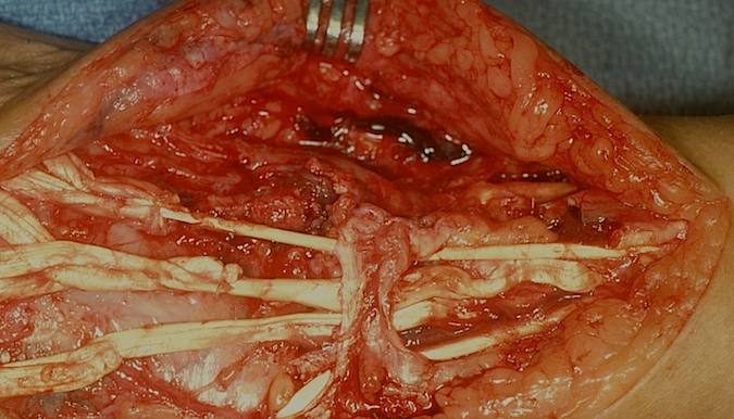 RA: Repaired extensor tendons with tendon transfers.