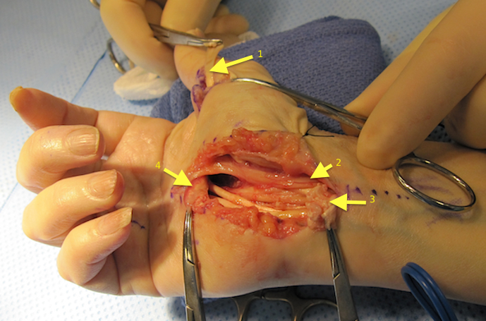 1 - Ring FDS transfer to distal ruptured FPL; 2 - Median Nerve; 3 - proximal ruptured flexor tendon ends; 4 - Distal ruptured flexor tendon ends