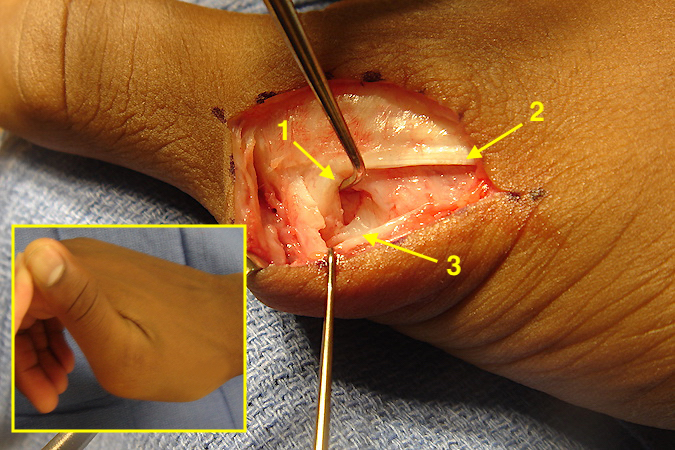 Dorsal radial approach to the right thumb MP joint torn radial collateral ligament.  Torn RCL (1) with probe in MP joint; EPB tendon (2);  Abductor aponeurosis (3).