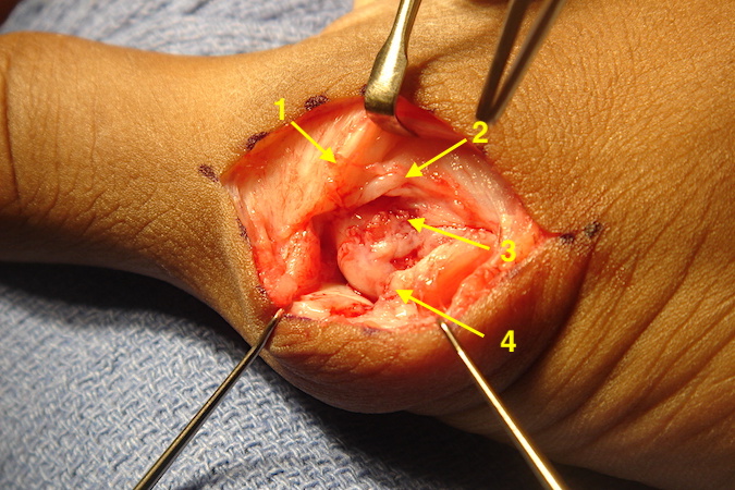 Right thumb MP joint with torn radial collateral ligament.  Edge of EPB (1) ; Dorsal MP joint capsule (2);  Insertion site of torn RCL (3); Radial collateral ligament (4).