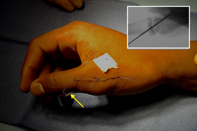 Right thumb MP joint after radial collateral ligament repaired, joint stabilized with a pin (arrow & insert) and skin incision sutured.