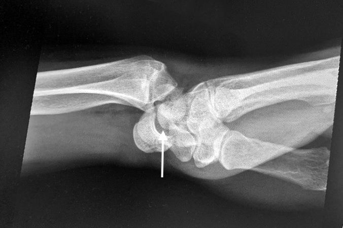 Lateral X-ray of a volar radial carpal dislocation in a 51 y.o. male involved in a MVA.  Note the associated mid-carpal gapping (arrow) suggesting some additional inter-carpal ligament damage.