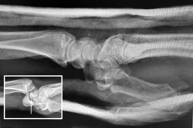  Volar radial carpal dislocation in a 51 y.o. male (insert) after closed reduction and before open ligament repair.