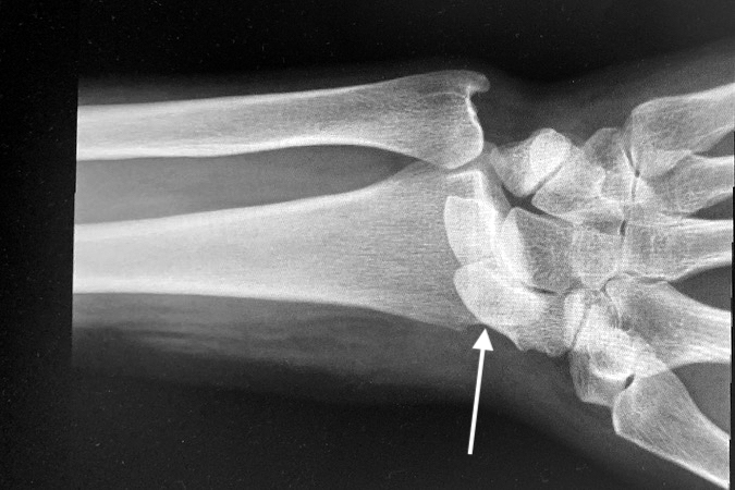 AP  X-ray of a volar radial carpal dislocation.  Note carpal bones (arrow) overlapping the distal radius.
