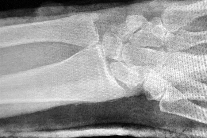  AP X-ray of volar radial carpal dislocation in a 51 y.o. male after closed reduction.