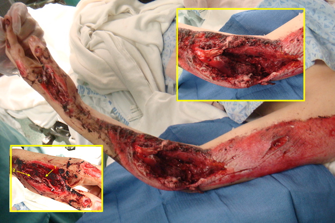 Severe injuries to the left upper extremity secondary to MVA. Insert bottom left shows open thumb metacarpal base fracture and lacerated thumb extensors (arrows). Insert top right shows massive injury to lateral elbow with a radial nerve segmental loss, loss of proximal extensor muscles, and loss of lateral epicondyle and half of the capitellum.