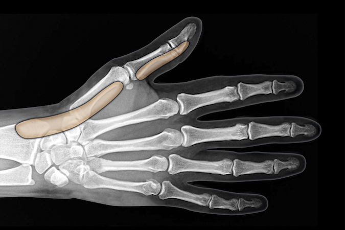 Thumb flexor tendon sheath shown separate but is connect to the radial bursa at the MP joint level and extends proximal to the transverse carpal ligament..