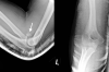 Adult left radial head fracture with displaced fragment (arrow) and comminution