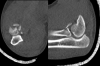 Adult left radial head fracture CT with displaced fragment and comminution