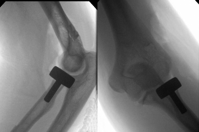 Adult left radial head fracture with displaced fragment and comminution treated by radial head replacement