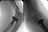 Adult left radial head fracture with displaced fragment and comminution treated by radial head replacement