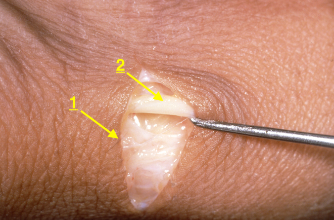 Radial sensory nerve: 1- Incision for release of the first extensor compartment; 2 - Dorsal radial sensory nerve  located in superficial subcutaneous tissue.