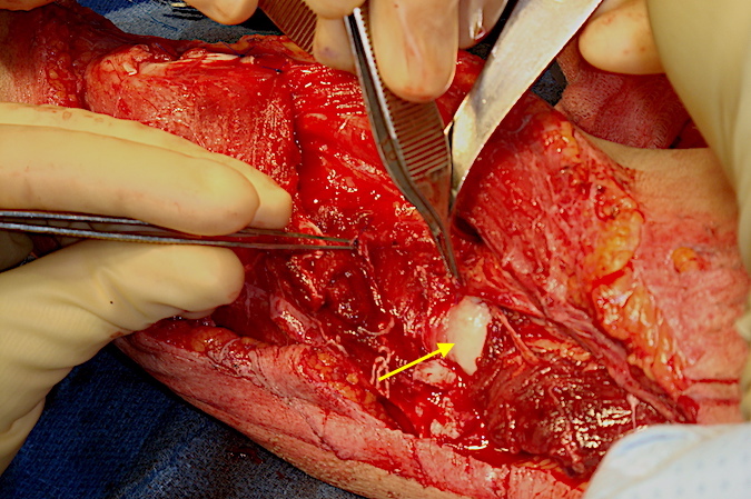 Lateral elbow after debridement with damaged distal and proximal radial nerve ends in the forceps.  Unsalvageable radial nerve extended proximally and distally.;  Capitellum (arrow).