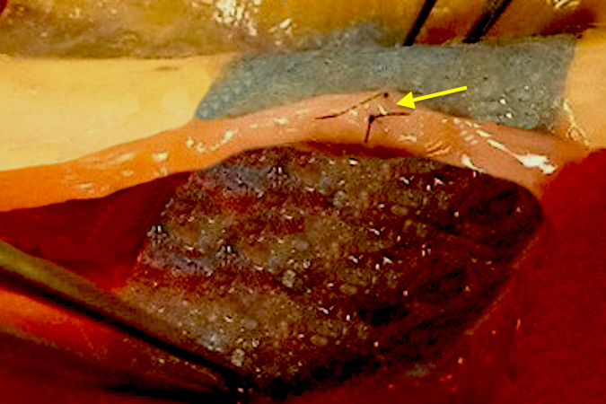 Another dorsal radial sensory nerve laceration (arrow) after epineural repair.