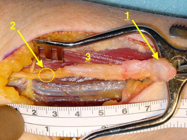 Radial sensory neuroma (1); Level of reaction and ligation; (3) Muscle which will receive the transposed proximal nerve end.