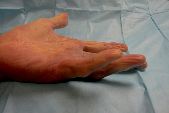 Raynaud's disease type changes in Dupuytren's Disease