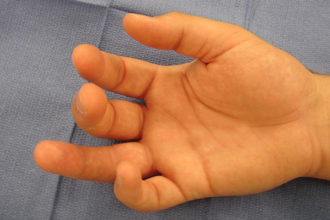 High School football player with limited flexion ring ring after an injury in last weekend's game