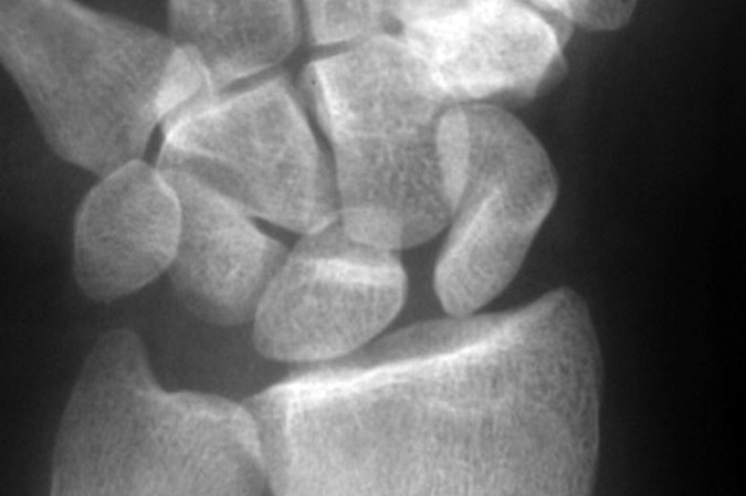 Left Scapholunate ligament rupture with lunate dislocation