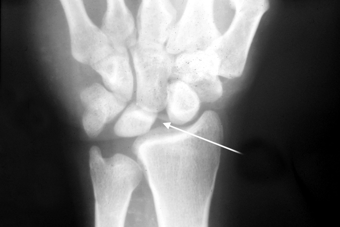Note right scapholunate acute rupture (arrow) with vertical scaphoid (wrist signet ring sign) and no perilunate dislocation