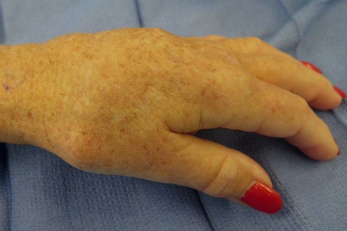 Chronic hand and wrist changes in a patient with scleroderma