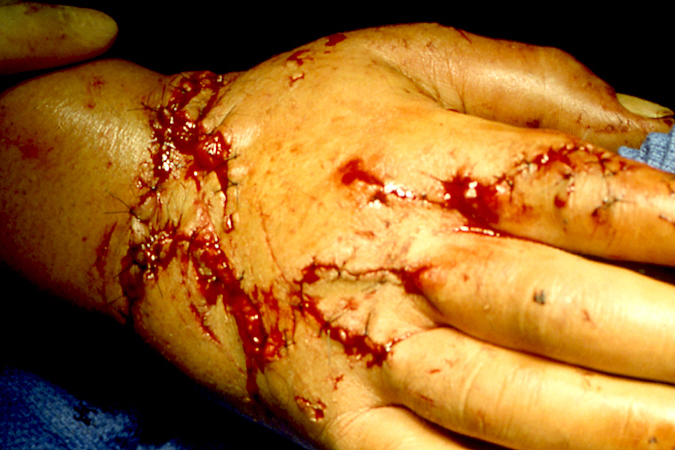 Open scapholunate acute laceration and cut extensor tendons after surgical repair.