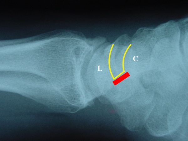 Do not remove the polar 10-15% of the cartilage.