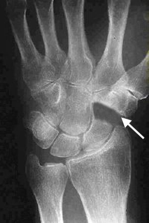 Distal scaphoid pole excision (arrow) for STT OA treatment