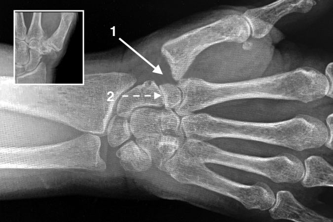 Combined STT & Thumb CMC OA (insert). This can not reliably be treated by trapeziectomy alone (1) because of residual ST OA (2).