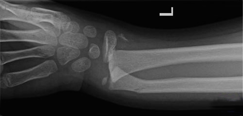 Salter II Fracture Distal Radius AP View