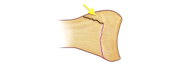 Salter II Fracture - Fracture line through growth plate (physis) and metaphysis. The metaphyseal fragment is called the Thurston-Holland fragment