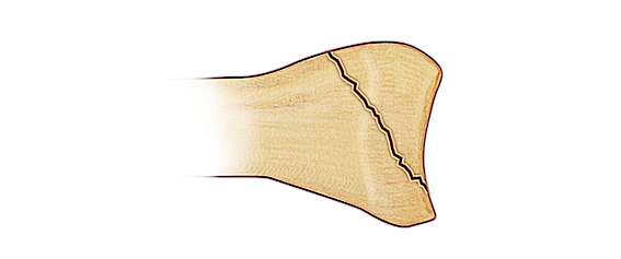 Salter IV Fracture - A vertical fracture line through metaphysis, the growth plate (physis) and the epiphysis and articular surface